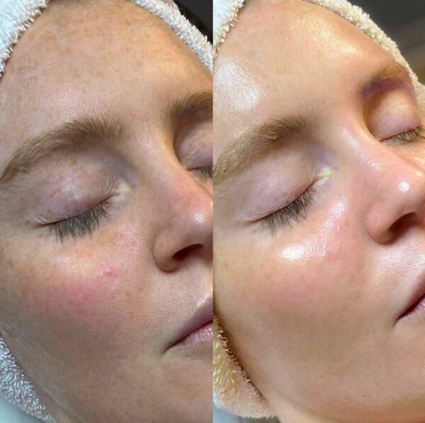 BeforeAndAfter-Hydrafacial2-600x598