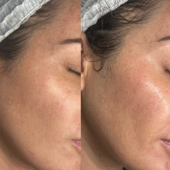 Hydra-Facial-1024x1024-1-600x600