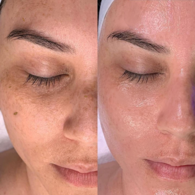 hydrafacial-before-and-after-2-1-400x400-1