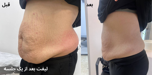 لیفت-بعد-از-یک-جلسه